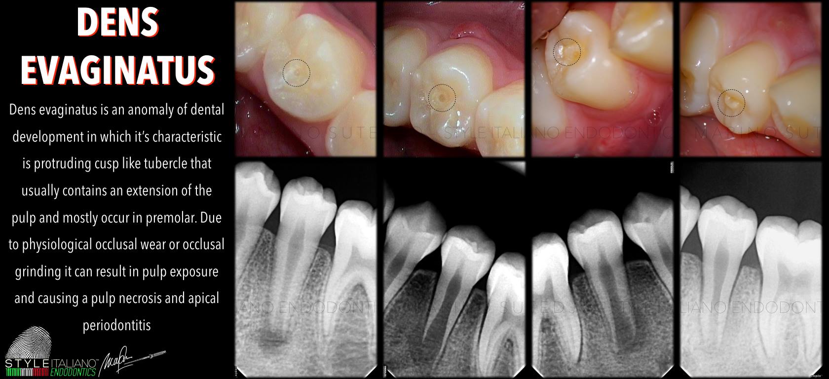 Xử lý núm phụ mặt nhai Dens Evaginatus🌱NHA KHOA MALL🌱