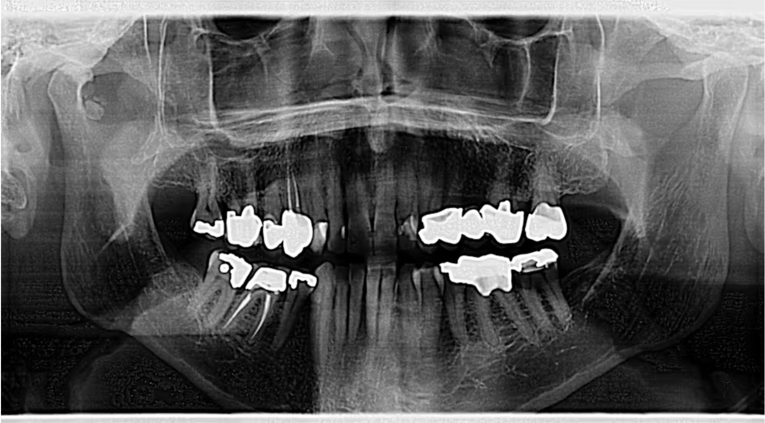 phat-hien-can-quang-tinh-co-tai-khop-thai-duong-ham