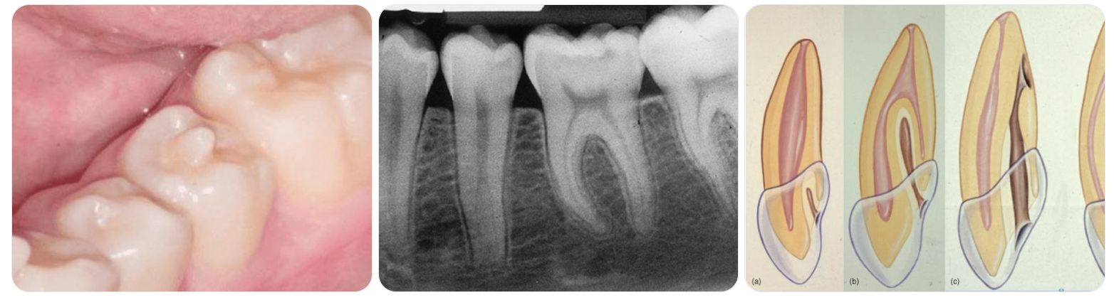 Xử lý núm phụ mặt nhai Dens Evaginatus🌱NHA KHOA MALL🌱