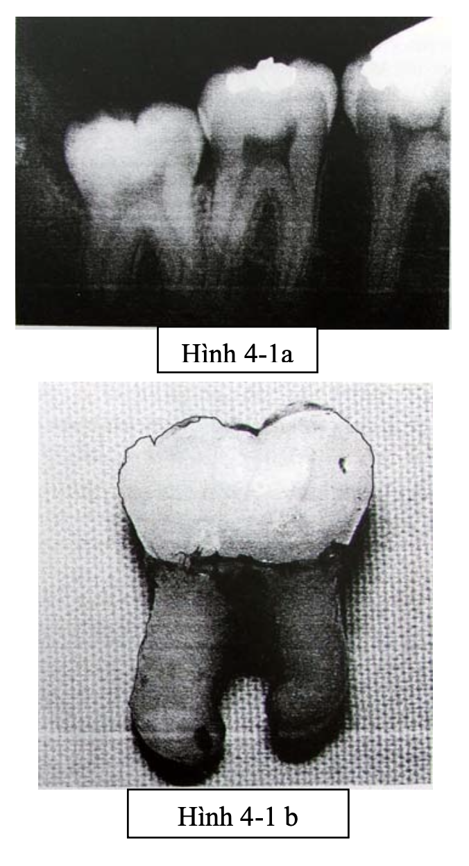 Phân loại răng khôn trên phương diện lâm sàng