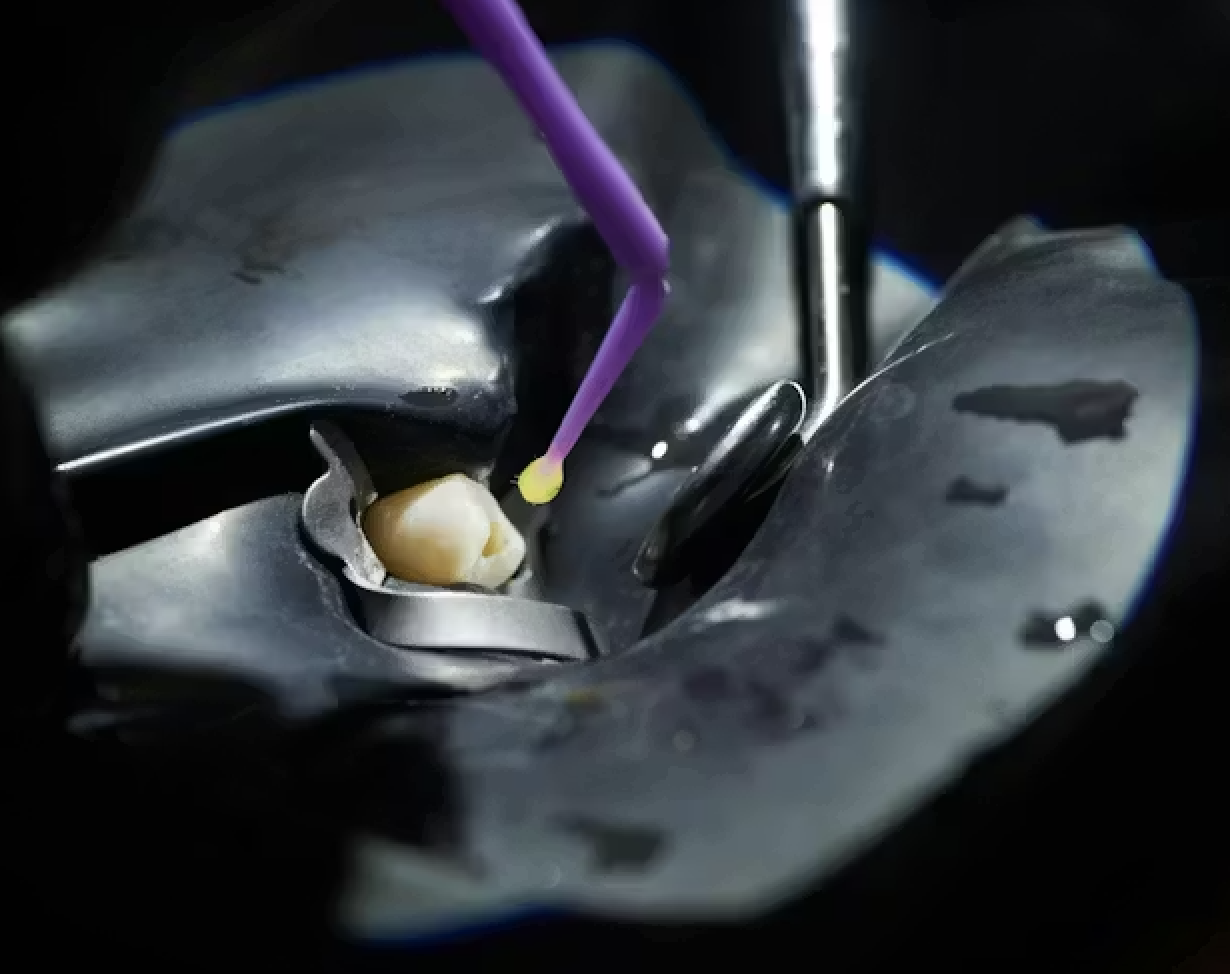 Bonding ngà răng: Những yếu tố ảnh hưởng đến độ bền lâu dài của phục hồi