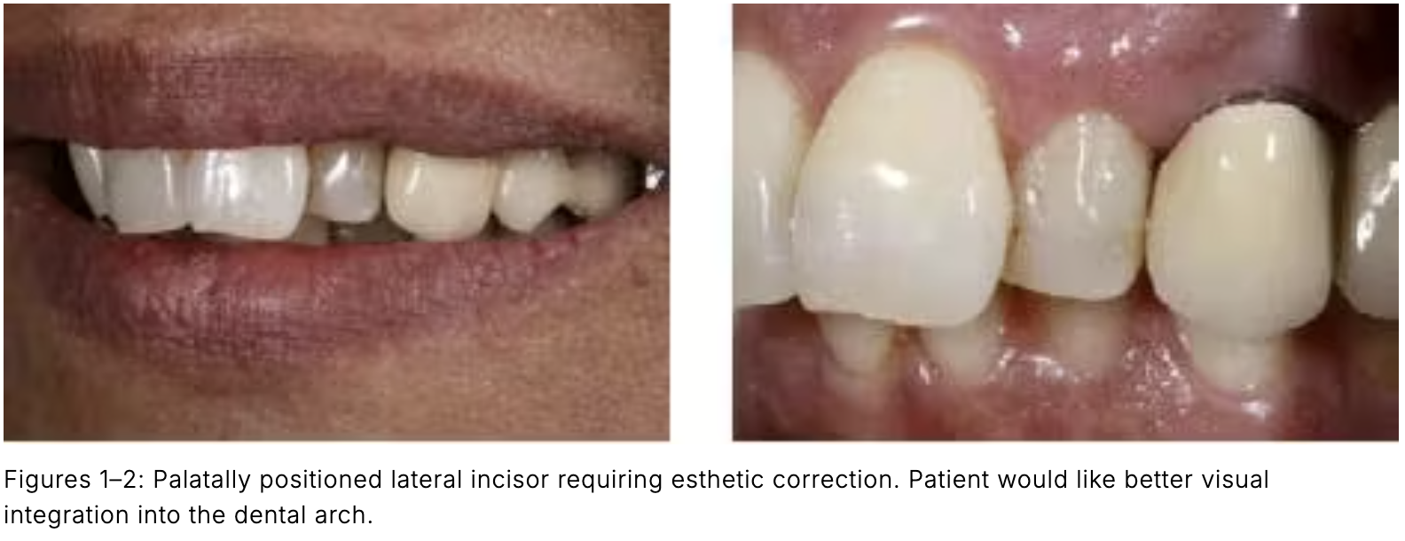 Composite phổ quát và veneer trực tiếp: Giải pháp tối ưu một lần hẹn cho phục hồi răng trước