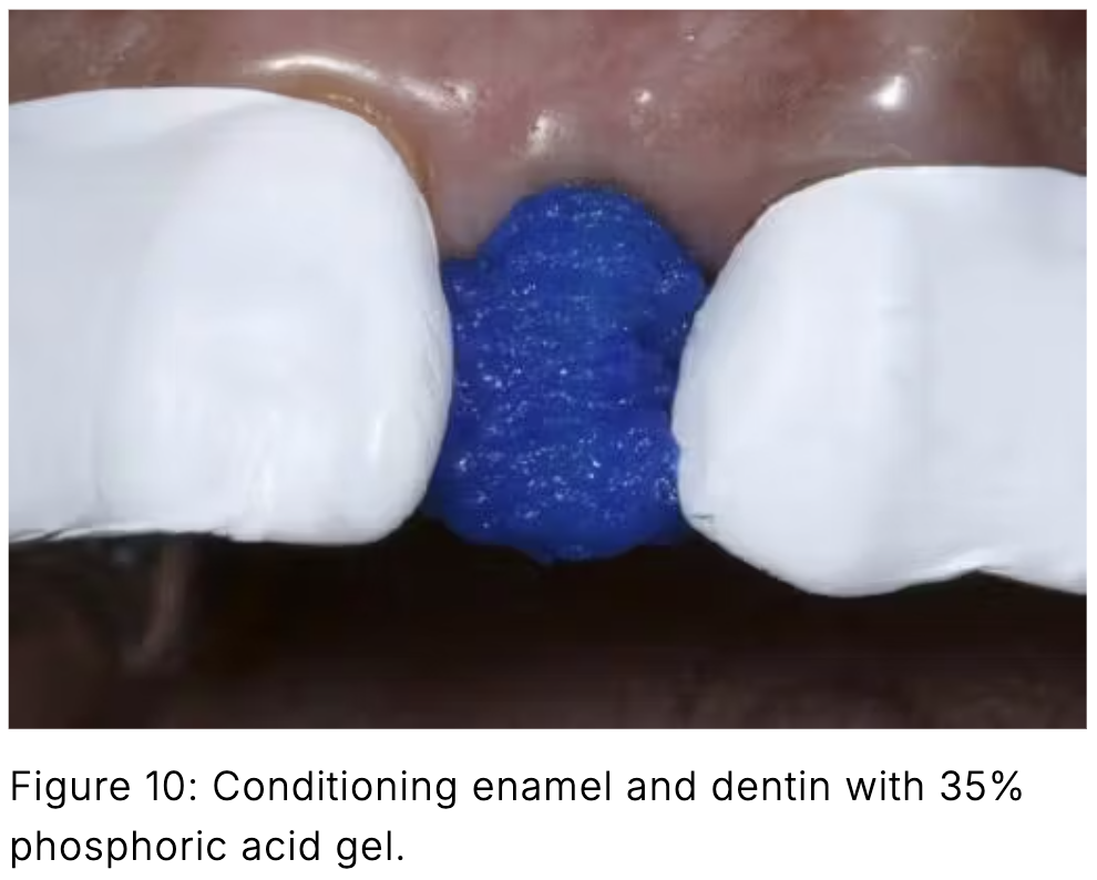 Composite phổ quát và veneer trực tiếp: Giải pháp tối ưu một lần hẹn cho phục hồi răng trước