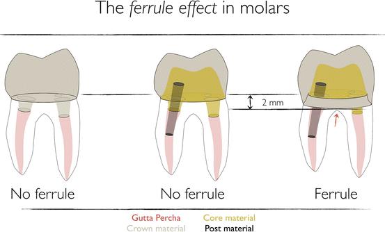 Hiệu ứng ferrule trong phục hồi răng đã điều trị nội nha