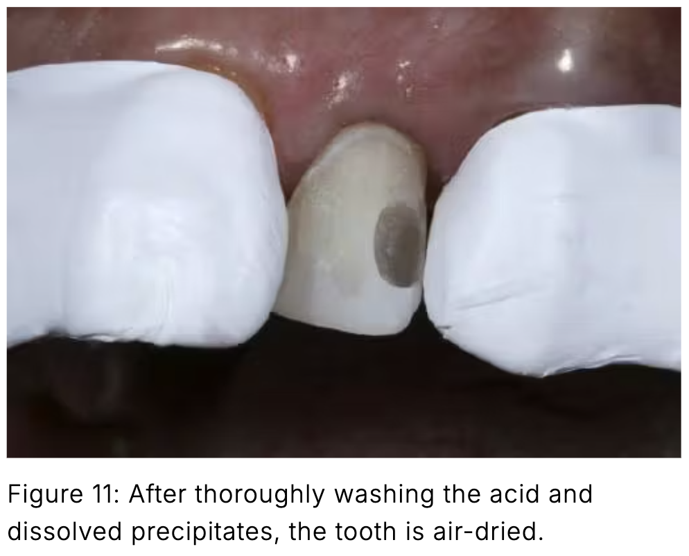 Composite phổ quát và veneer trực tiếp: Giải pháp tối ưu một lần hẹn cho phục hồi răng trước