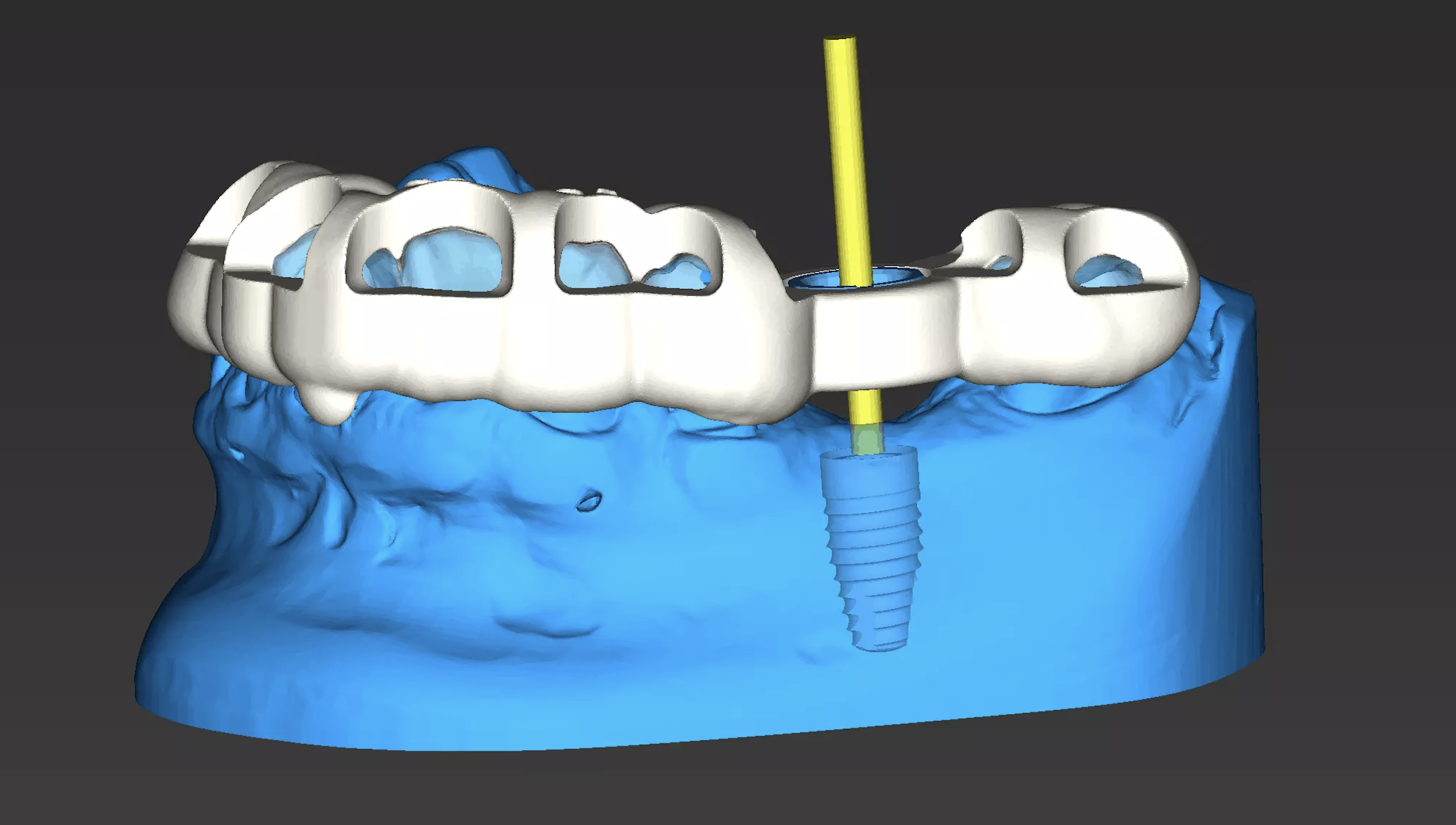 vai-tro-cua-cbct-va-mang-huong-dan-phau-thuat-trong-cay-ghep-implant
