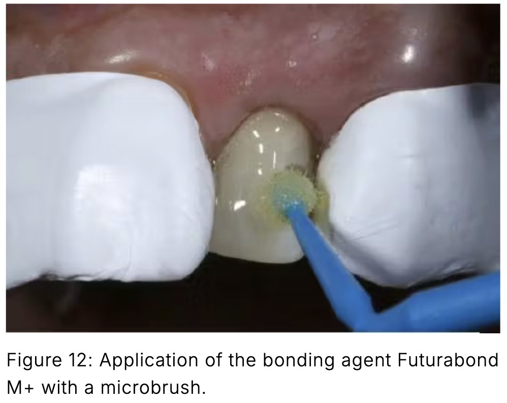 Composite phổ quát và veneer trực tiếp: Giải pháp tối ưu một lần hẹn cho phục hồi răng trước