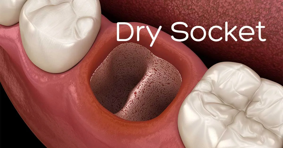 Viêm huyệt ổ răng khô sau nhổ răng: Dấu hiệu, nguyên nhân và cách xử lý hiệu quả