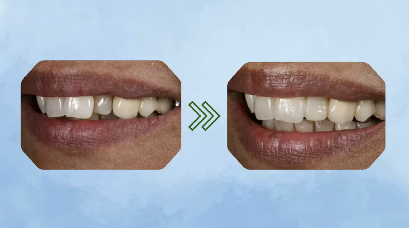 Composite phổ quát và veneer trực tiếp: Giải pháp tối ưu một lần hẹn cho phục hồi răng trước