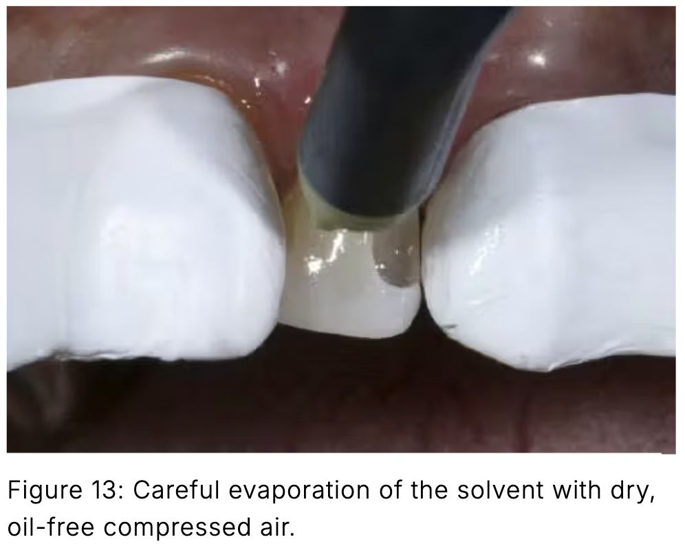 Composite phổ quát và veneer trực tiếp: Giải pháp tối ưu một lần hẹn cho phục hồi răng trước