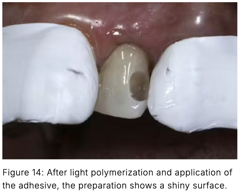 Composite phổ quát và veneer trực tiếp: Giải pháp tối ưu một lần hẹn cho phục hồi răng trước