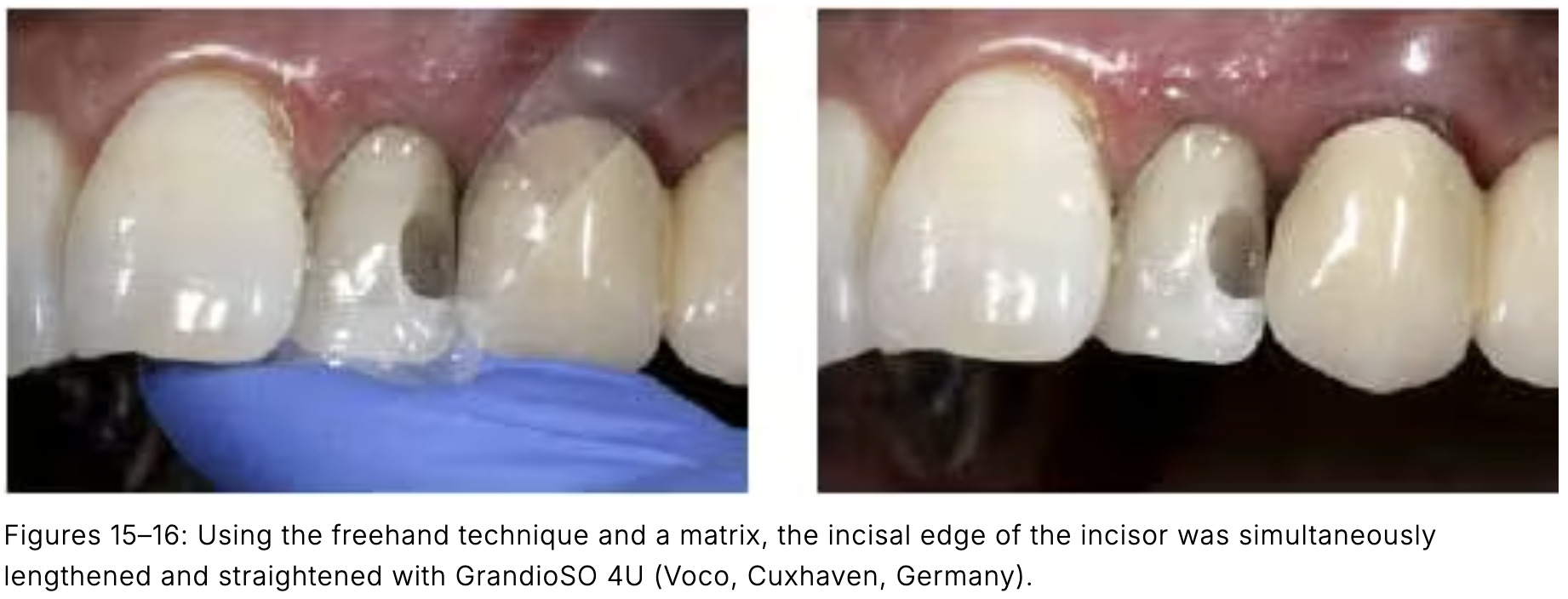 Composite phổ quát và veneer trực tiếp: Giải pháp tối ưu một lần hẹn cho phục hồi răng trước