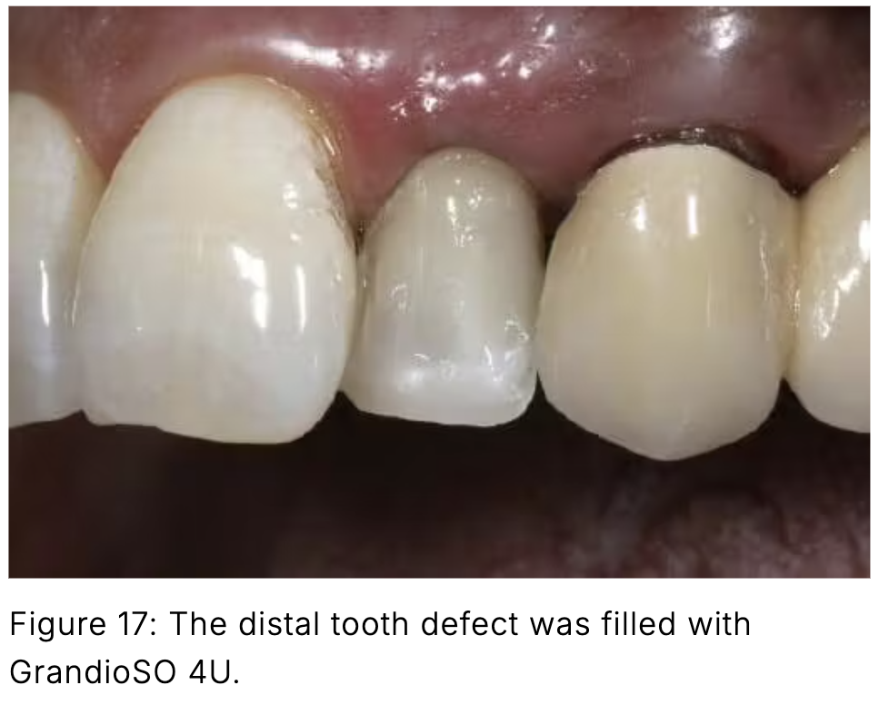 Composite phổ quát và veneer trực tiếp: Giải pháp tối ưu một lần hẹn cho phục hồi răng trước