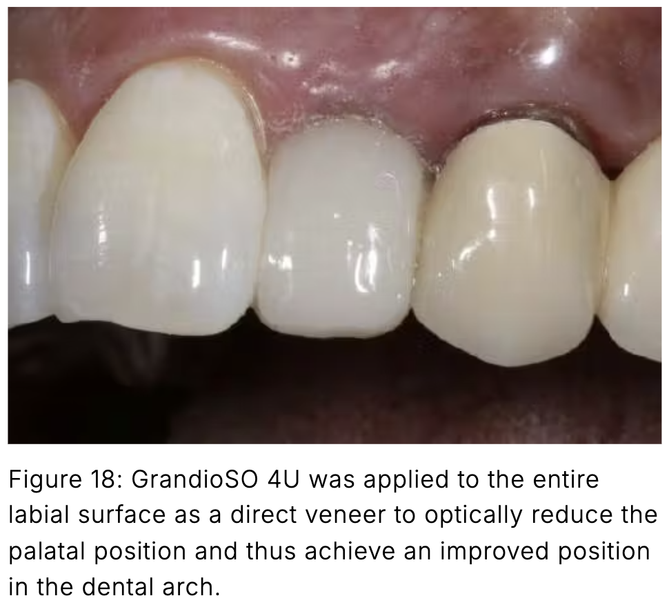 Composite phổ quát và veneer trực tiếp: Giải pháp tối ưu một lần hẹn cho phục hồi răng trước