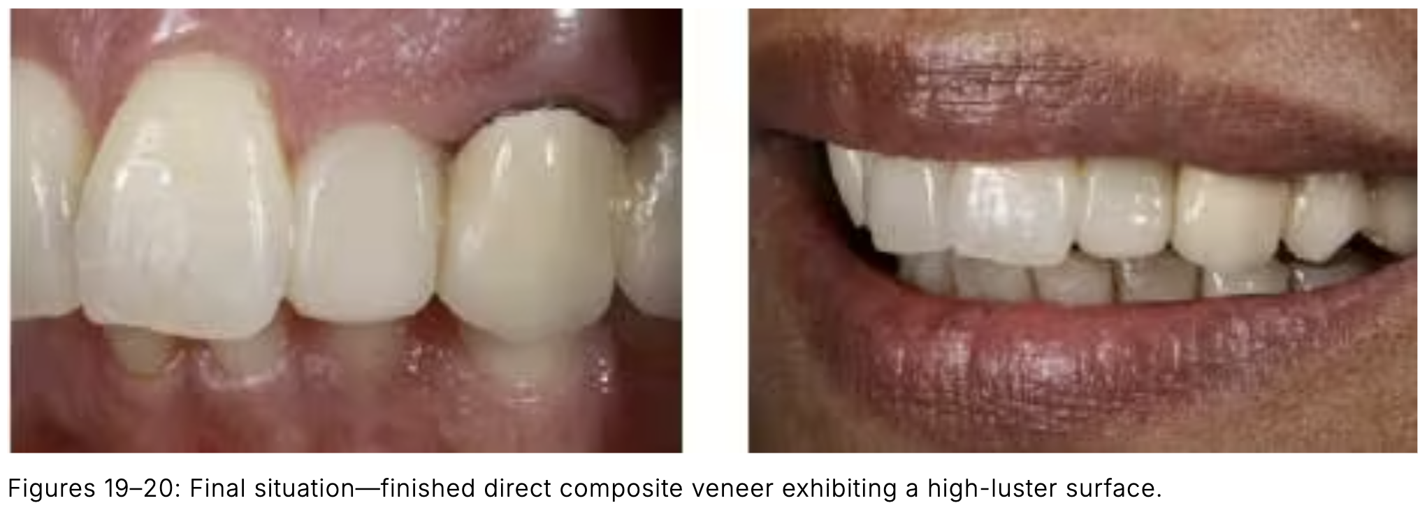 Composite phổ quát và veneer trực tiếp: Giải pháp tối ưu một lần hẹn cho phục hồi răng trước