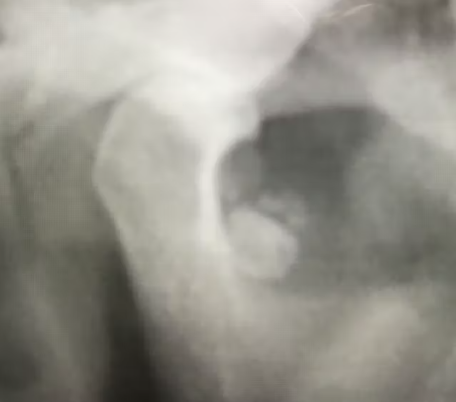 phat-hien-can-quang-tinh-co-tai-khop-thai-duong-ham