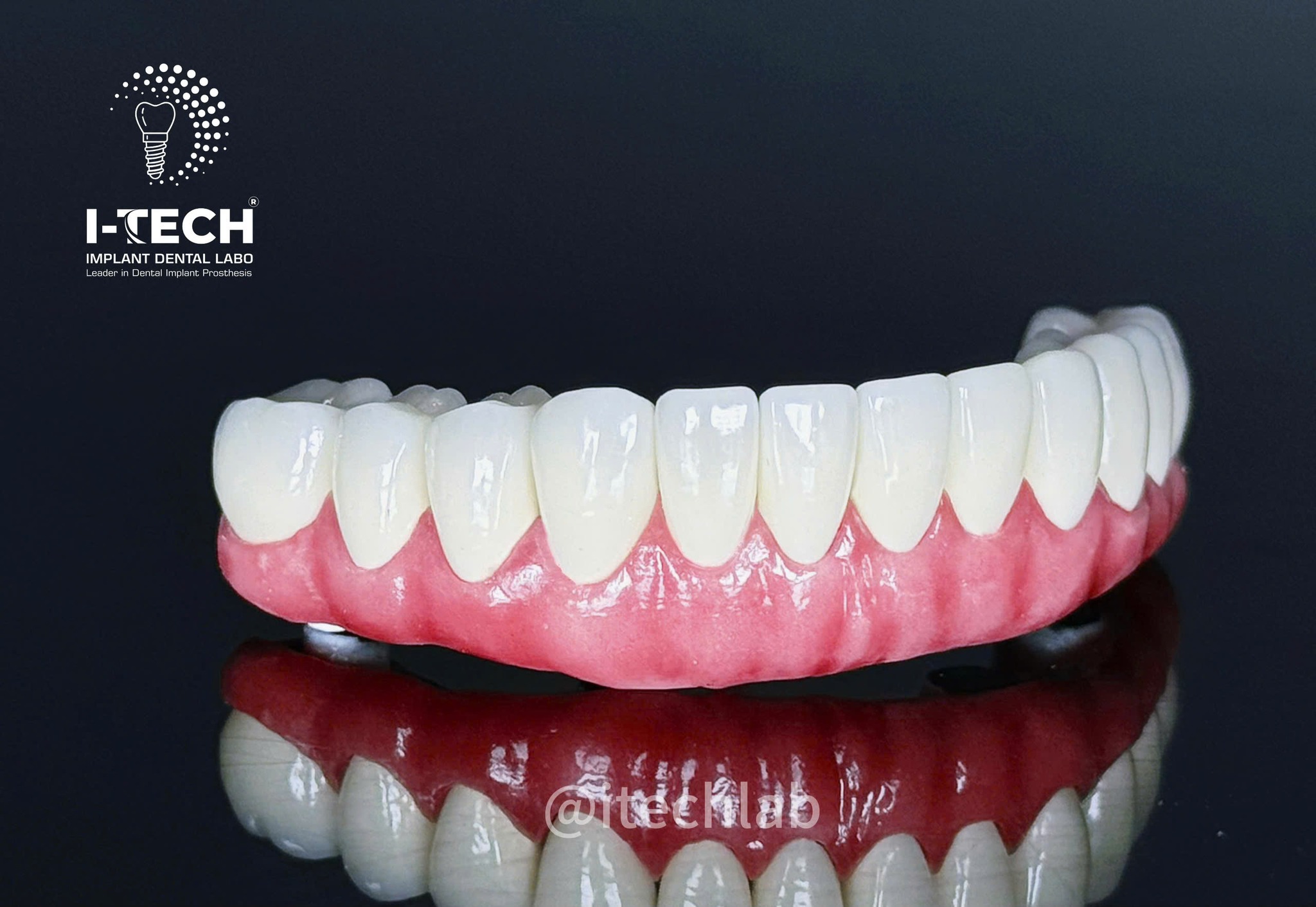 Phục hình Thimble Bar All-on-4 in 3D Cr-Co: Giải pháp cho phục hình toàn hàm trên implant