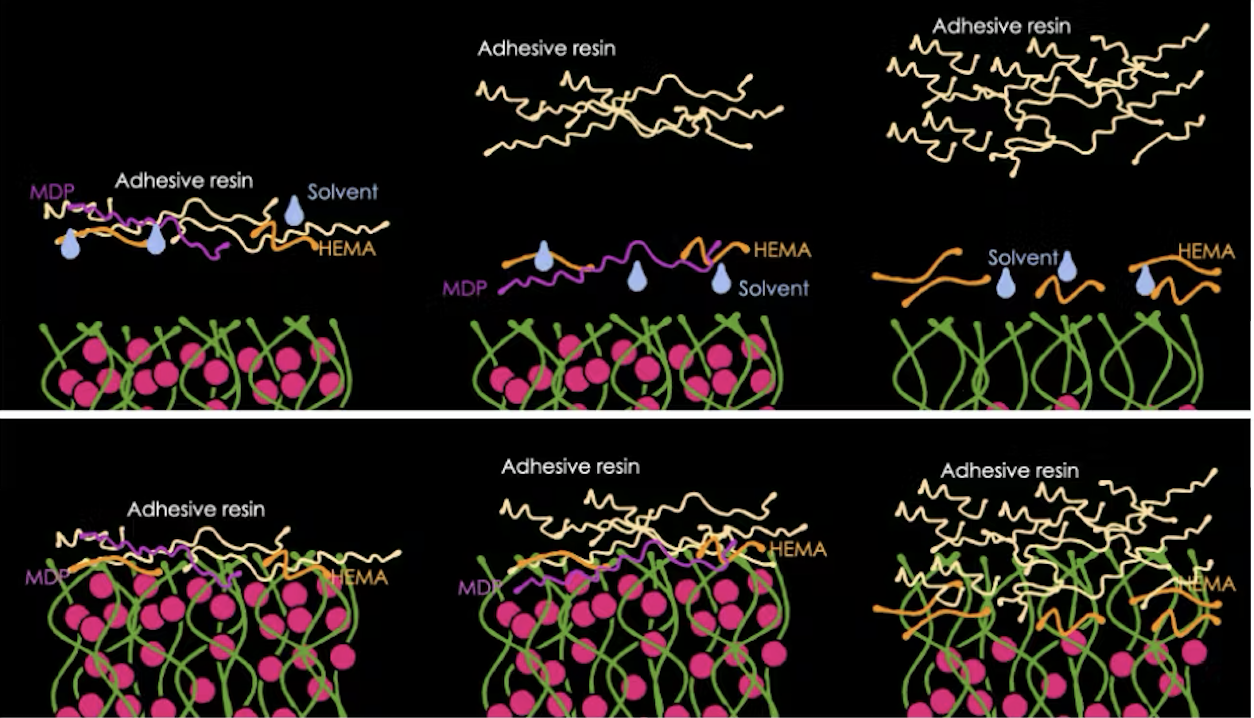 Bonding ngà răng: Những yếu tố ảnh hưởng đến độ bền lâu dài của phục hồi
