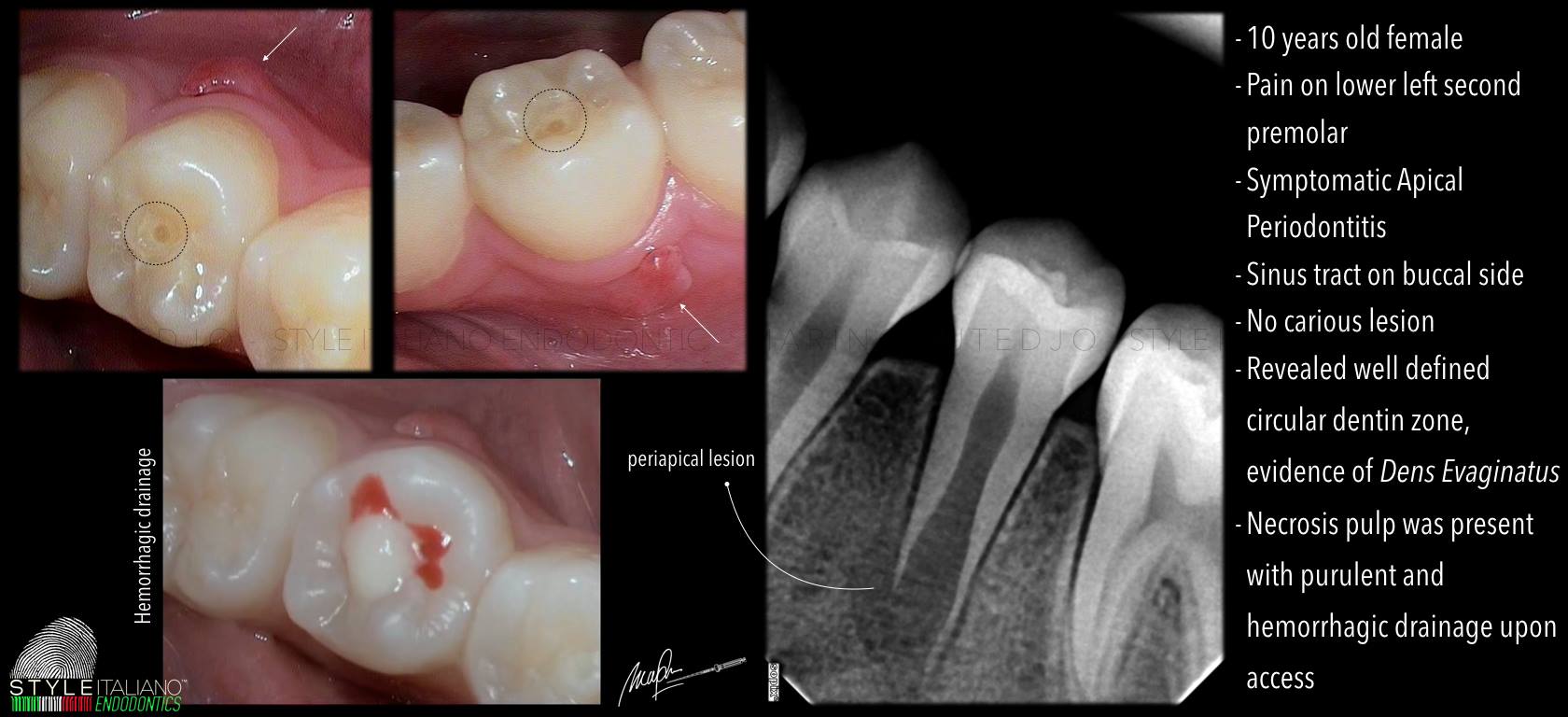 Xử lý núm phụ mặt nhai Dens Evaginatus🌱NHA KHOA MALL🌱