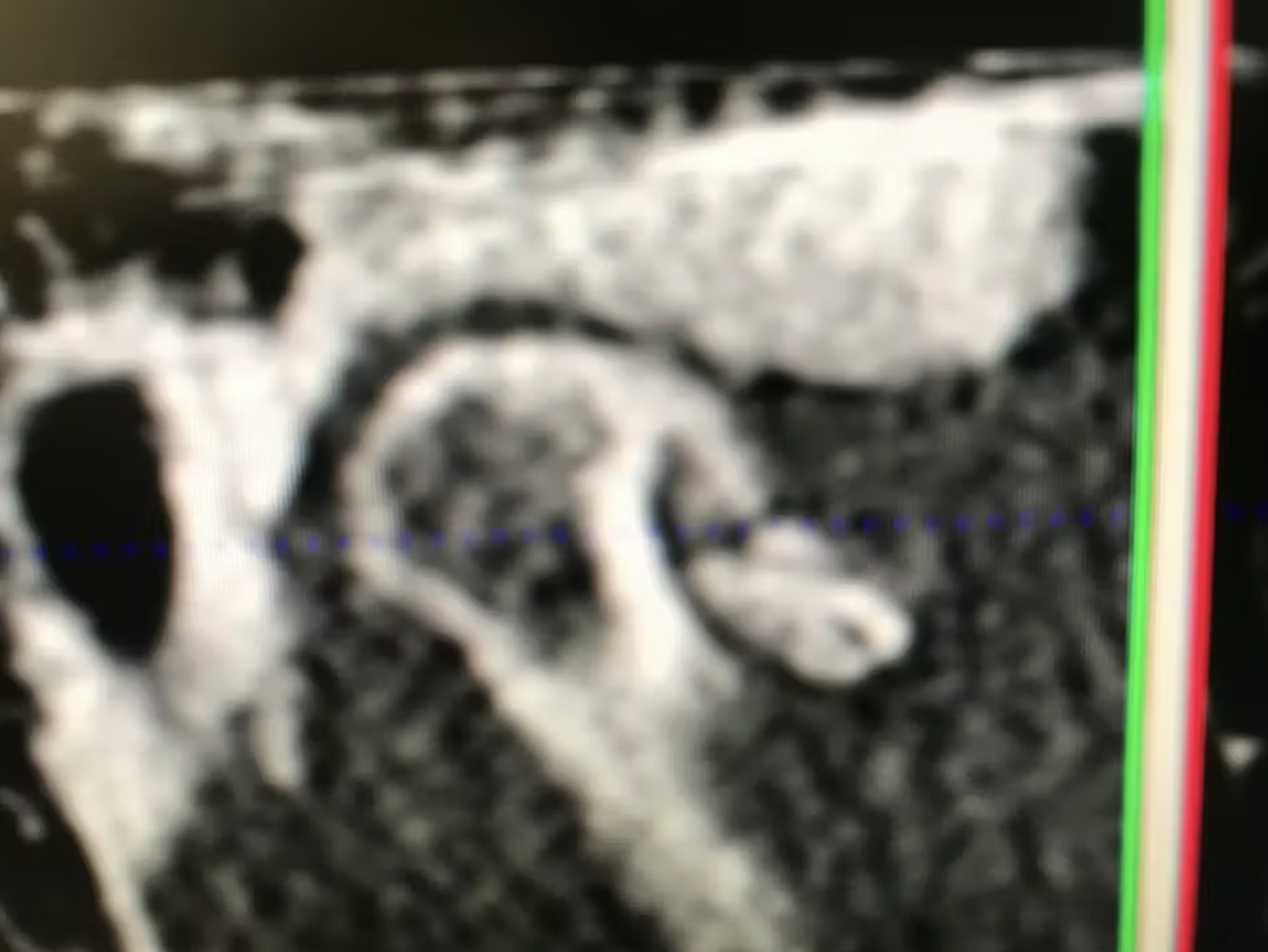 phat-hien-can-quang-tinh-co-tai-khop-thai-duong-ham