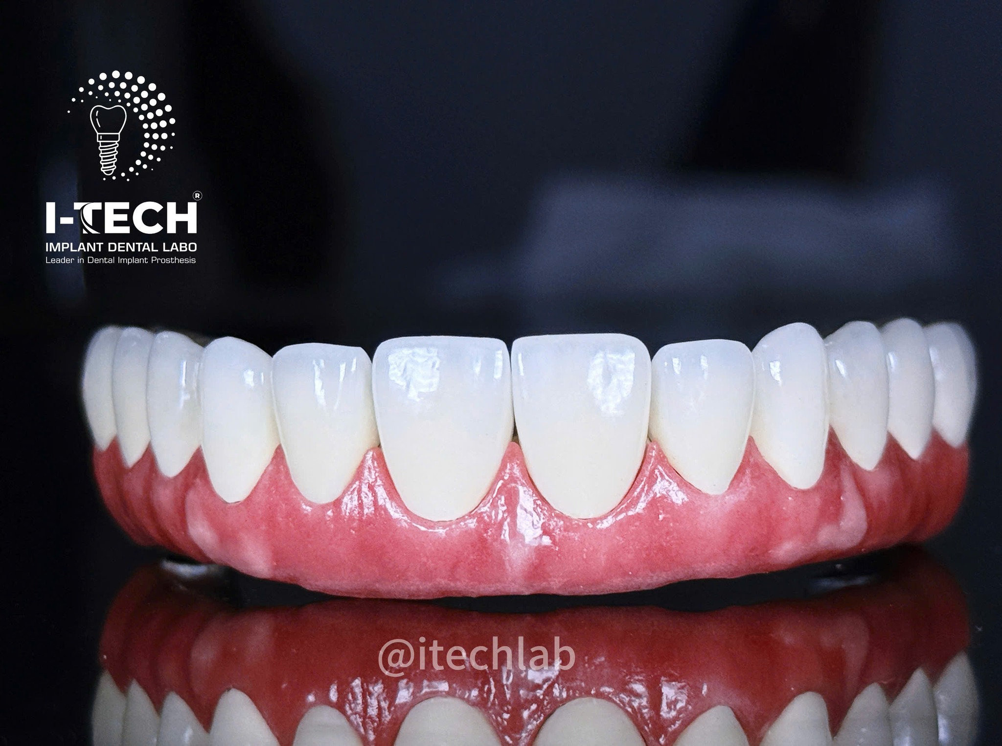 Phục hình Thimble Bar All-on-4 in 3D Cr-Co: Giải pháp cho phục hình toàn hàm trên implant