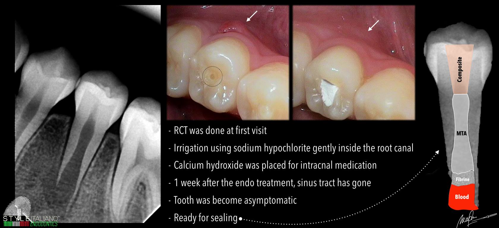 Xử lý núm phụ mặt nhai Dens Evaginatus🌱NHA KHOA MALL🌱