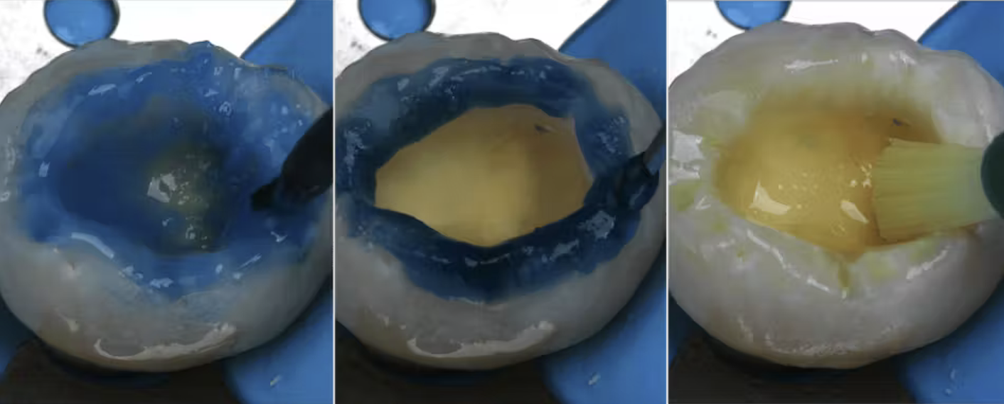 Bonding ngà răng: Những yếu tố ảnh hưởng đến độ bền lâu dài của phục hồi