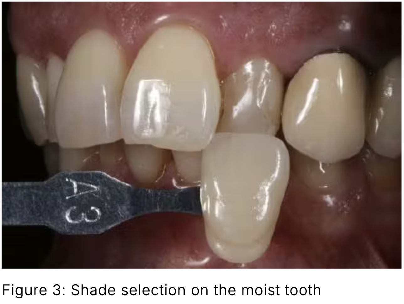 Composite phổ quát và veneer trực tiếp: Giải pháp tối ưu một lần hẹn cho phục hồi răng trước