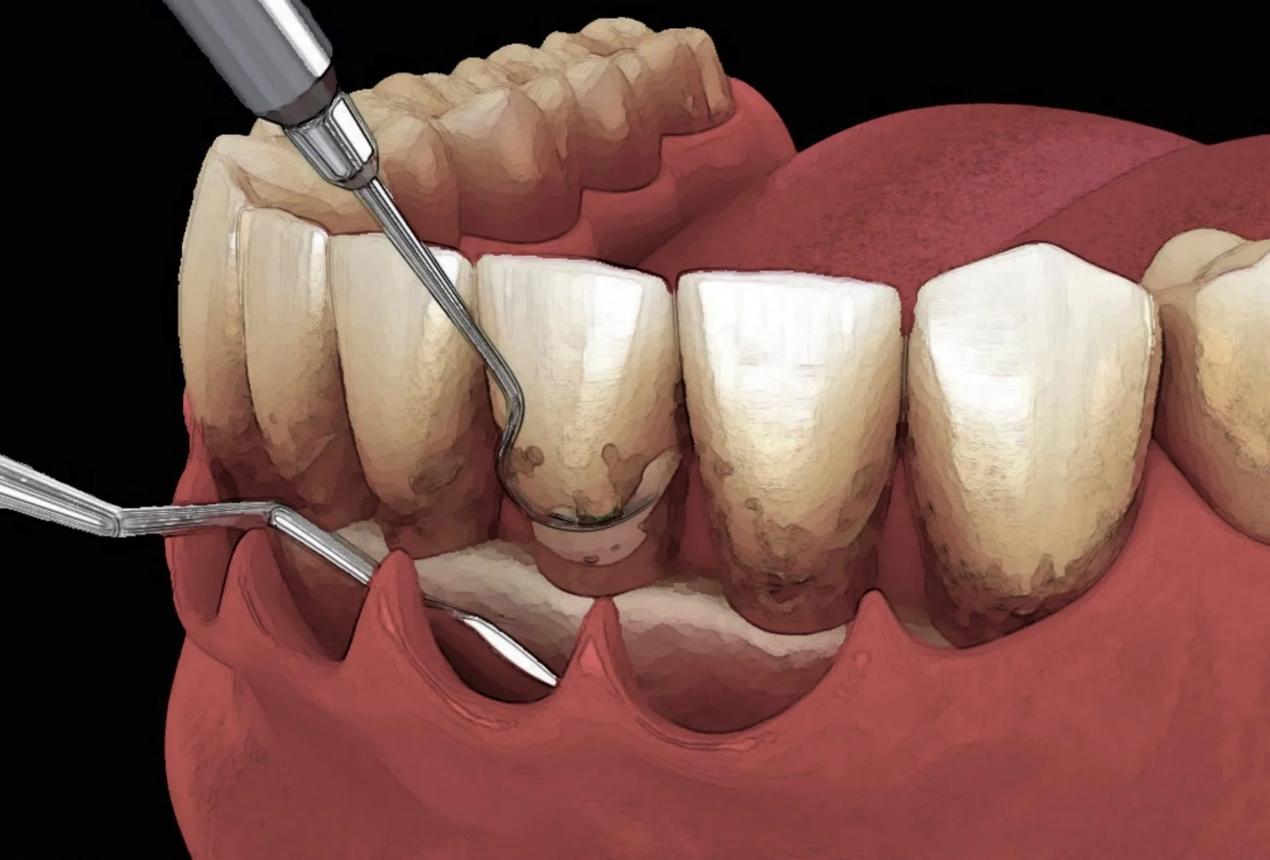 5 Hiểu Lầm Phổ Biến Của Bệnh Nhân Nha Khoa