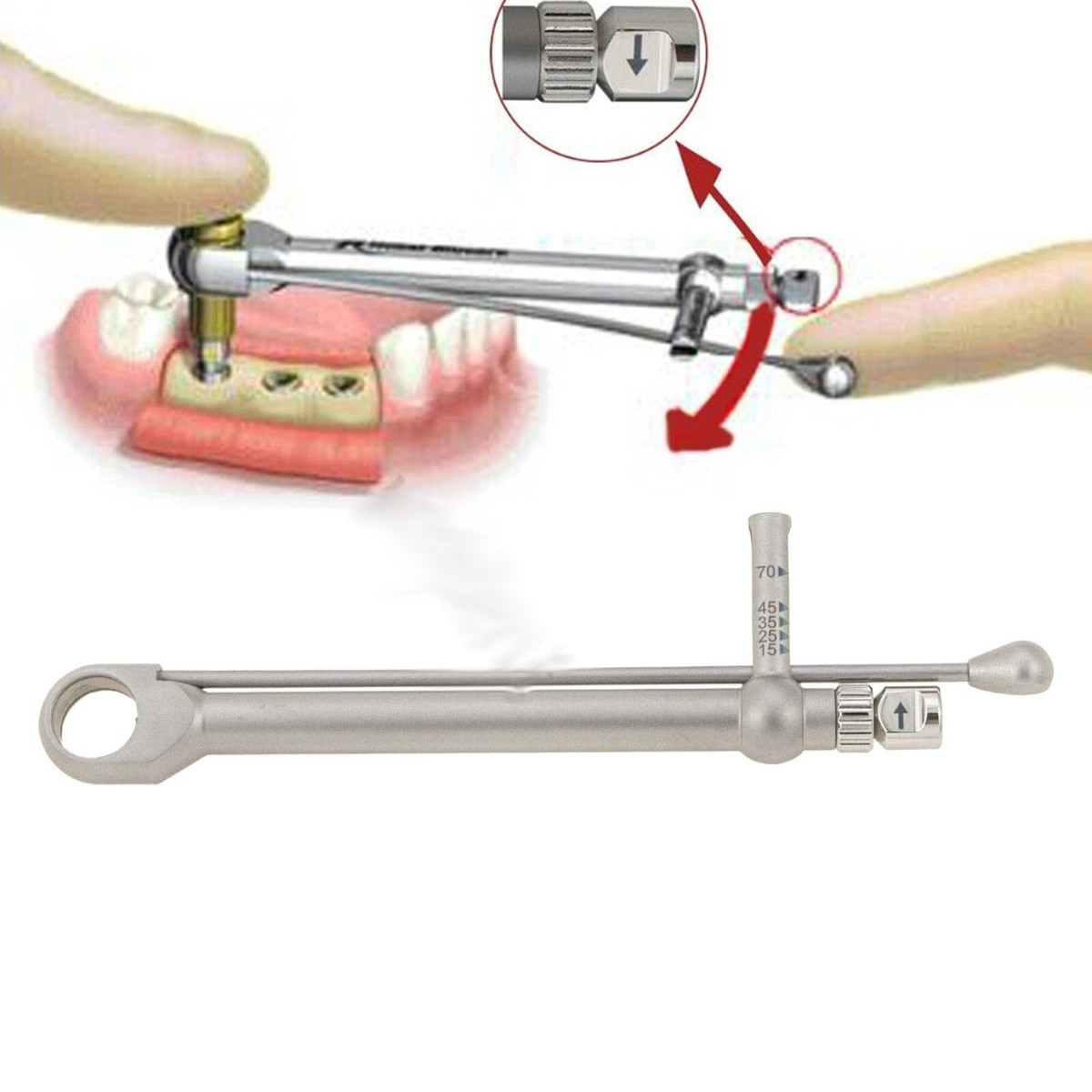 Sai số trên cây đo lực torque implant nha khoa: Nguyên nhân gây lỏng vít và giải pháp