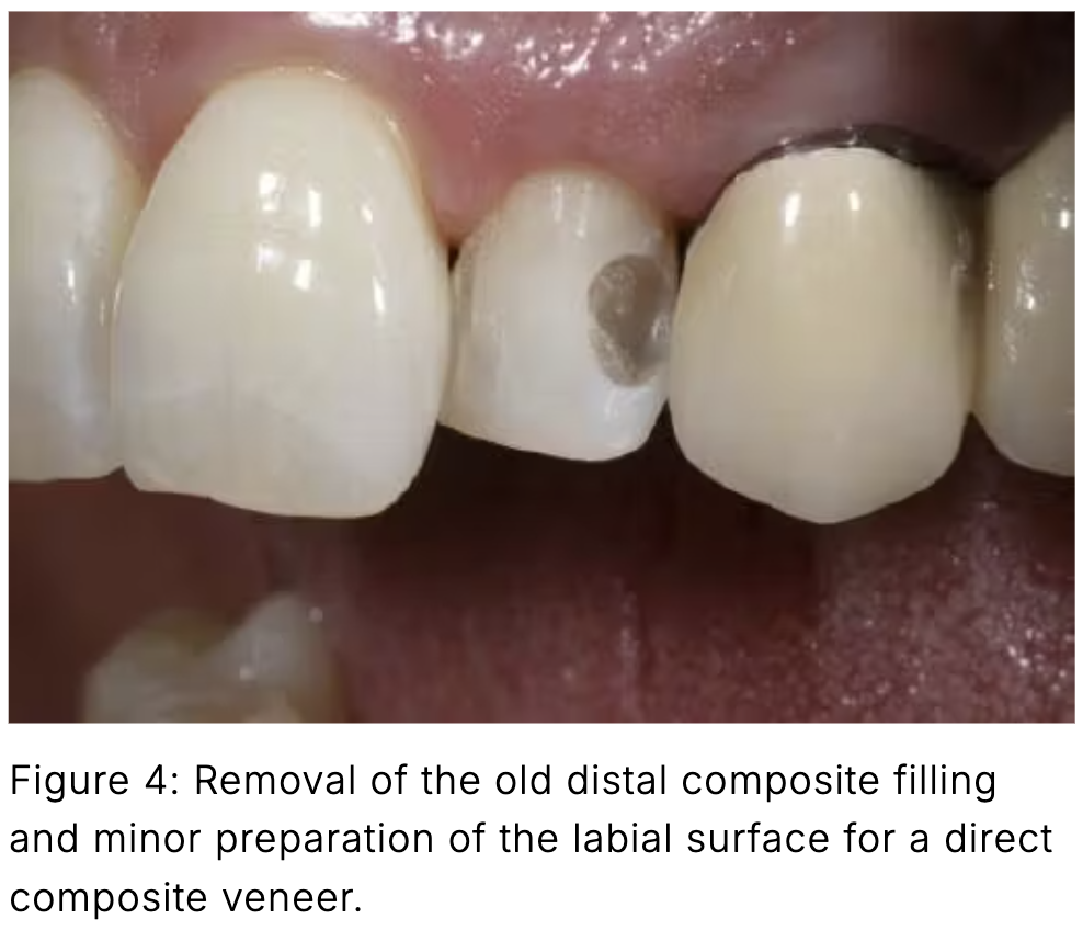 Composite phổ quát và veneer trực tiếp: Giải pháp tối ưu một lần hẹn cho phục hồi răng trước