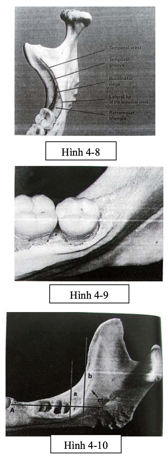 Phân loại răng khôn trên phương diện lâm sàng