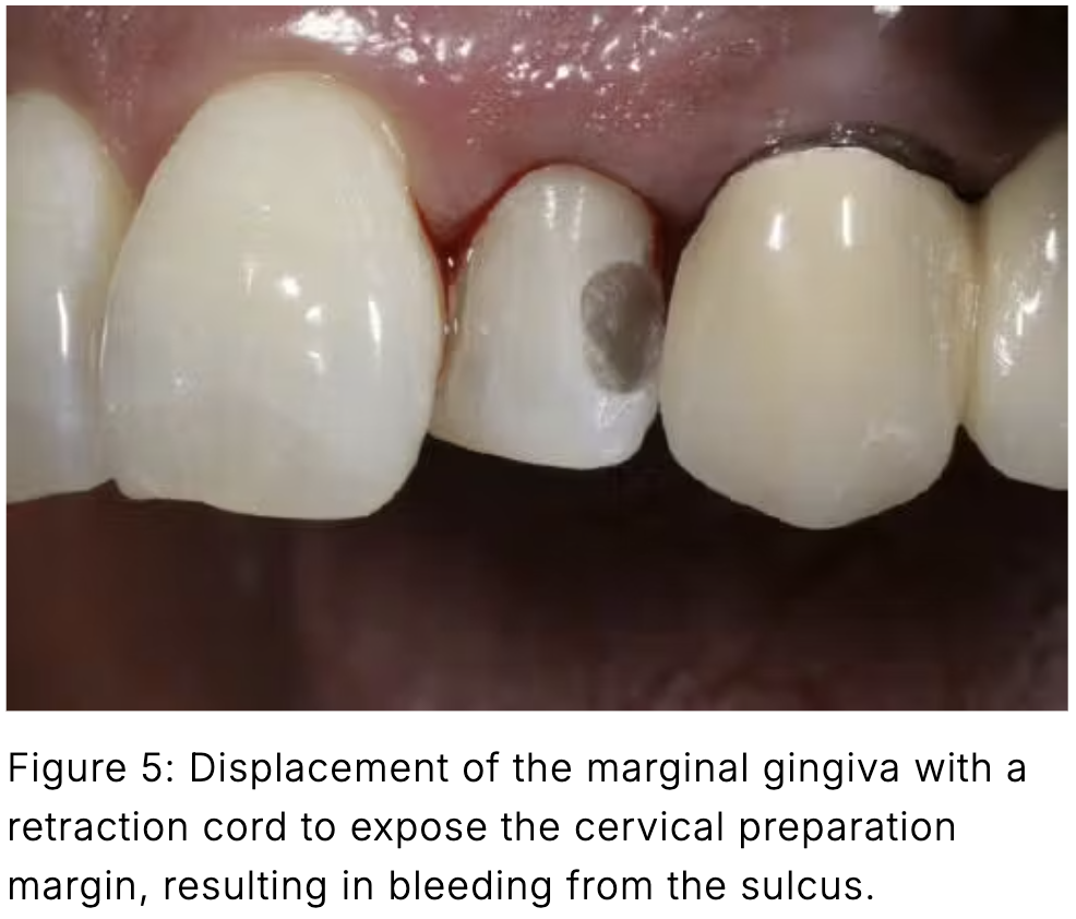 Composite phổ quát và veneer trực tiếp: Giải pháp tối ưu một lần hẹn cho phục hồi răng trước