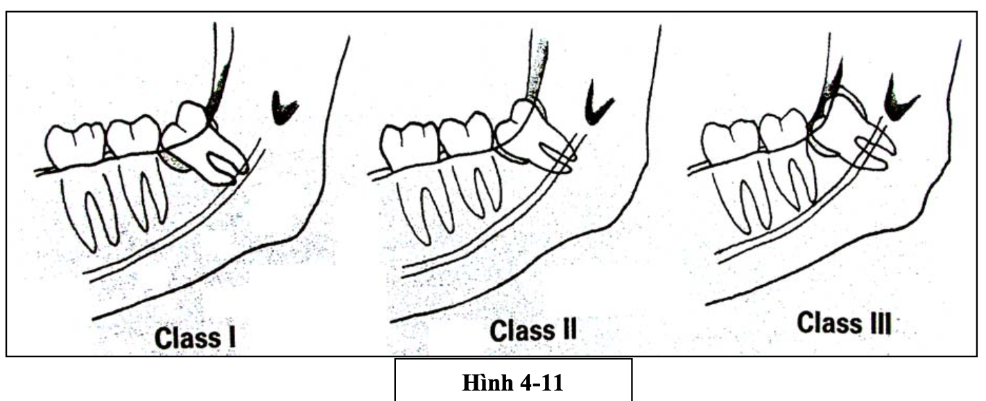 Phân loại răng khôn trên phương diện lâm sàng