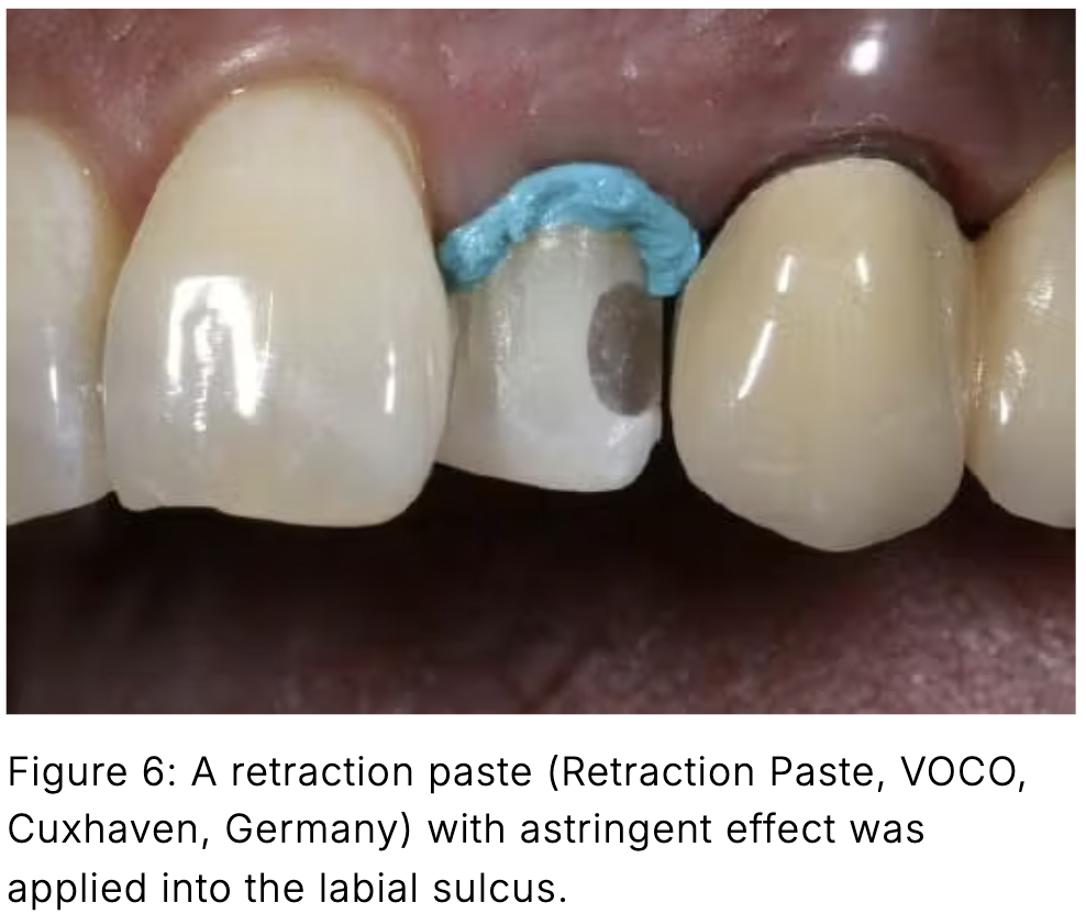 Composite phổ quát và veneer trực tiếp: Giải pháp tối ưu một lần hẹn cho phục hồi răng trước