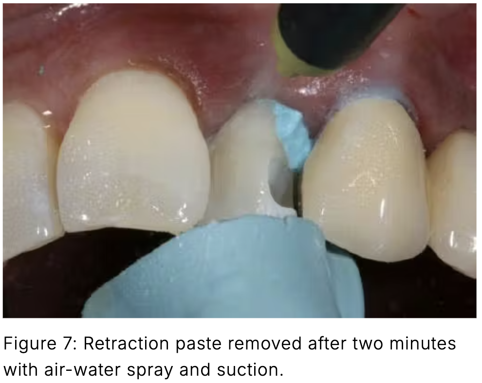 Composite phổ quát và veneer trực tiếp: Giải pháp tối ưu một lần hẹn cho phục hồi răng trước