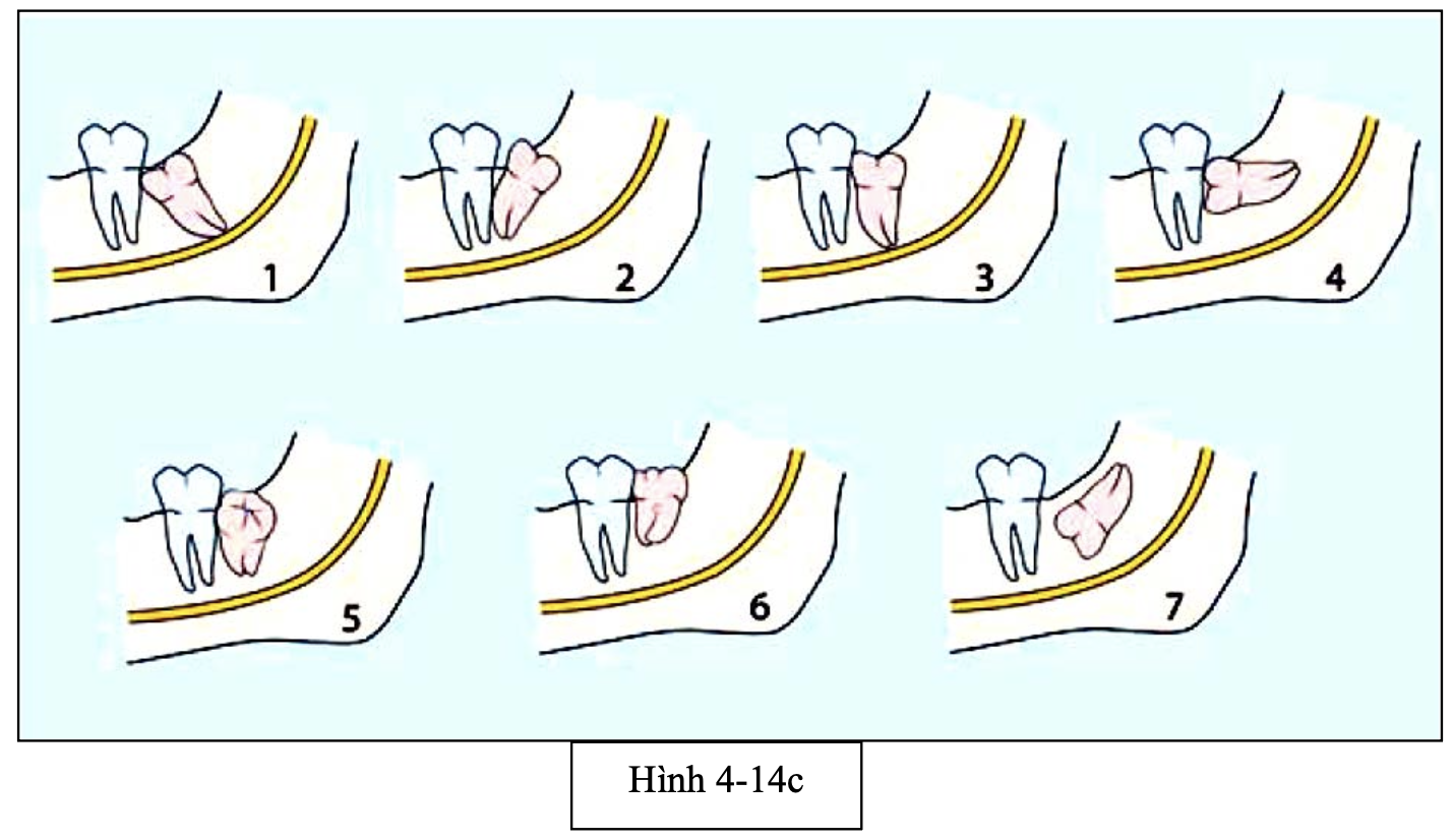 Phân loại răng khôn trên phương diện lâm sàng