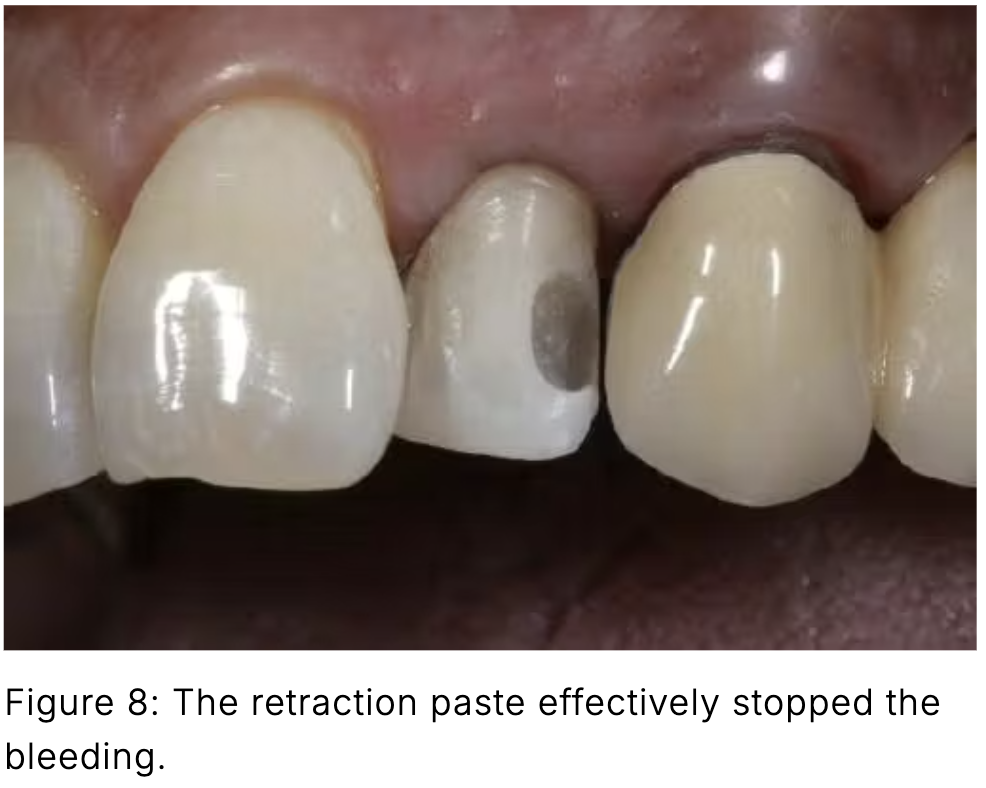 Composite phổ quát và veneer trực tiếp: Giải pháp tối ưu một lần hẹn cho phục hồi răng trước