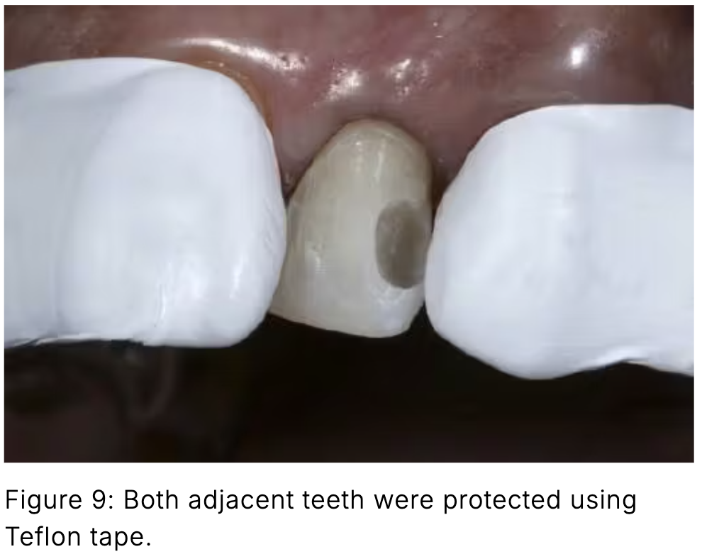 Composite phổ quát và veneer trực tiếp: Giải pháp tối ưu một lần hẹn cho phục hồi răng trước