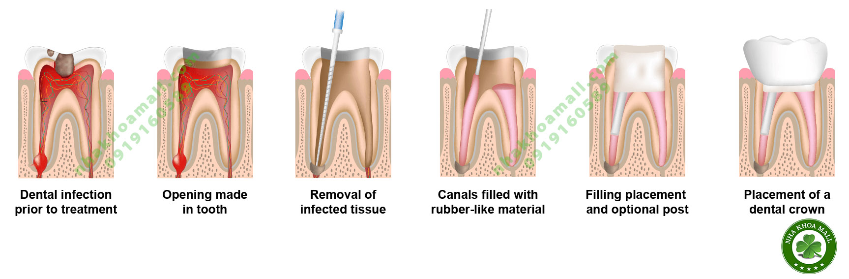 điều trị nội nha là gì