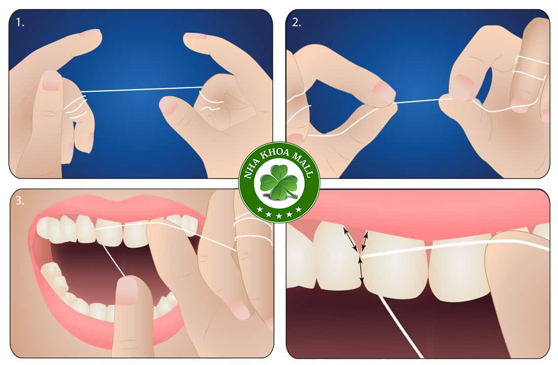 Sử dụng chỉ nha khoa để hoàn thiện việc làm sạch kẽ răng