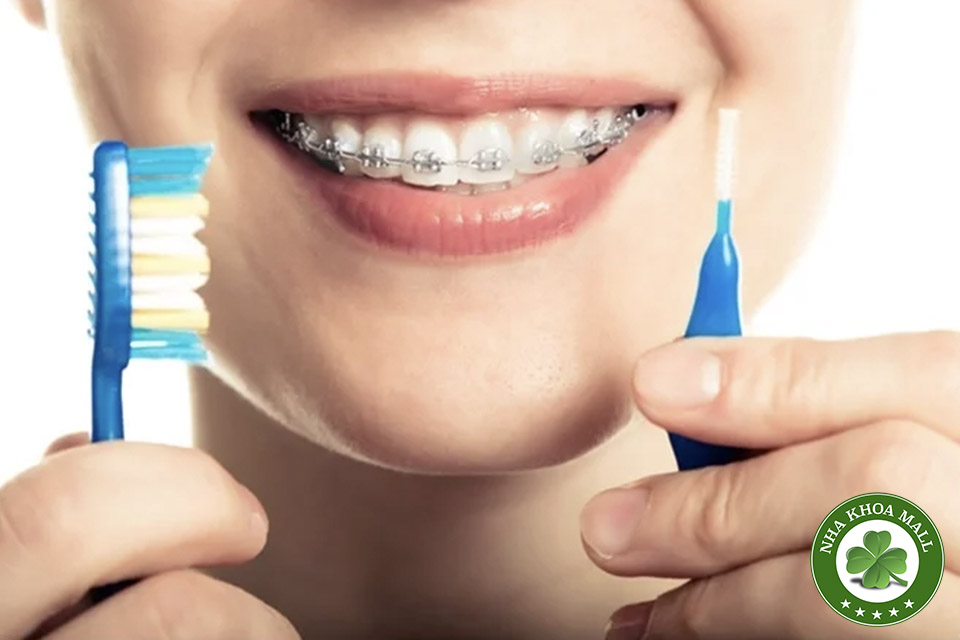 4 Mẹo Vàng Giúp Ngăn Ngừa Sâu Răng Khi Đeo Mắc Cài Niềng Răng