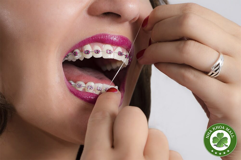 4 Mẹo Vàng Giúp Ngăn Ngừa Sâu Răng Khi Đeo Mắc Cài Niềng Răng