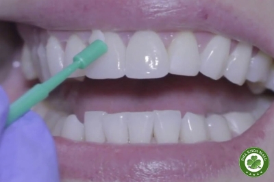 3M ESPE Clinpro White Varnish – Giải pháp ngừa sâu răng hiệu quả cho trẻ em và người lớn