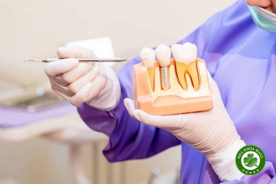 Điều Cần Biết Trước Khi Triển Khai Dịch Vụ Implant Tại Nha Khoa