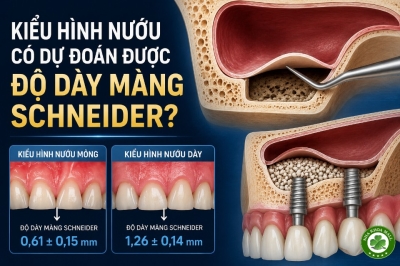 Kiểu hình nướu có dự đoán được độ dày màng Schneider? Góc nhìn lâm sàng trước phẫu thuật nâng xoang hàm