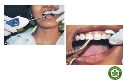 Quy trình sử dụng máy thử tủy răng trong nha khoa 