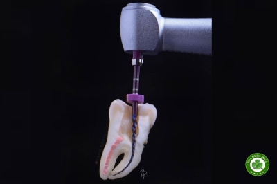Cách giảm nguy cơ gãy trâm nội nha khi điều trị ống tủy cong và có khấc