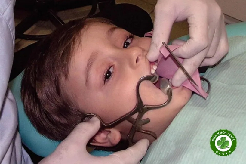 Banh miệng bắt buộc cho trẻ em: Dụng cụ không thể thiếu trong nha khoa nhi