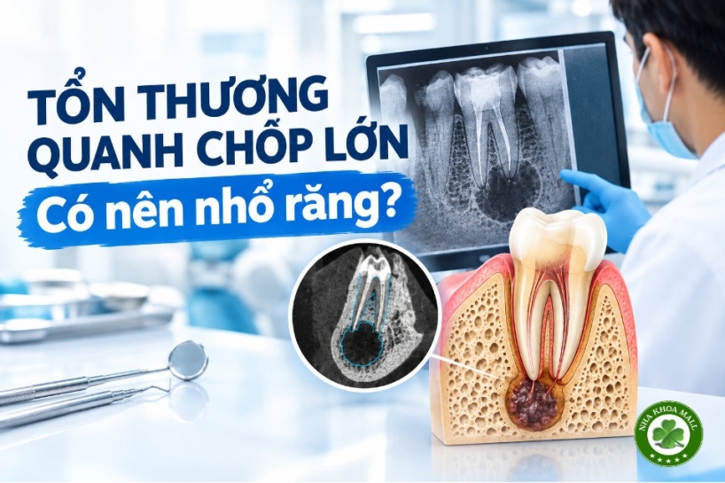 Tổn thương quanh chóp lớn: Khi nào nên điều trị bảo tồn thay vì nhổ răng?